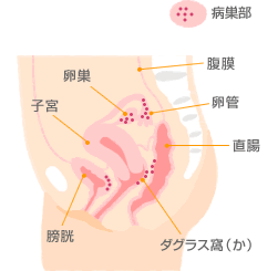 子宮内膜症とは