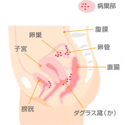 子宮内膜症｜盛岡市の今井産婦人科内科クリニック